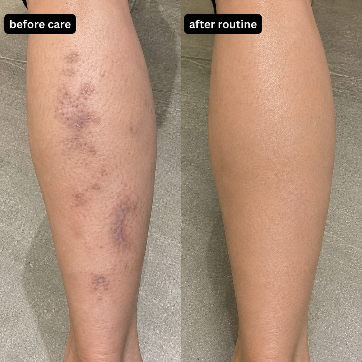 SCAR REMOVAL CREAM